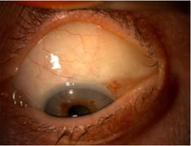 An image demonstrating a trabeculectomy bleb under the upper eyelid.