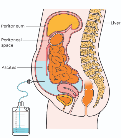 Diagram illustrating the area that the drain is inserted (image courtesy of Macmillan Cancer Support).