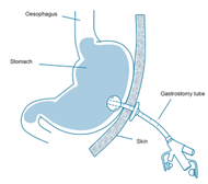 A diagram of a gastroscopy feeding tube.