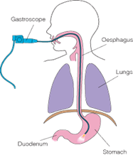 A diagram of a person having a gastroscopy.