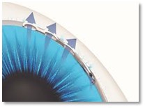 An image of an eye. There are three hours pointing out from the eye.