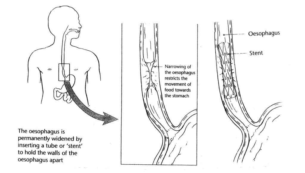 A diagram of an oesophageal stent.