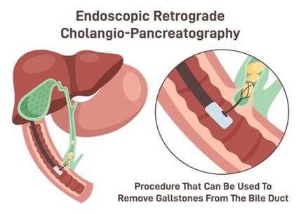 A diagram showing the procedure of a endoscopic retrograde cholangio-pancreatography.
