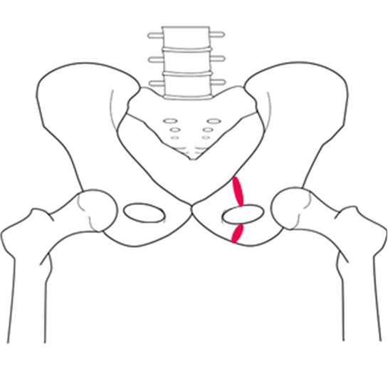 Pubic bone diagram showing a fracture